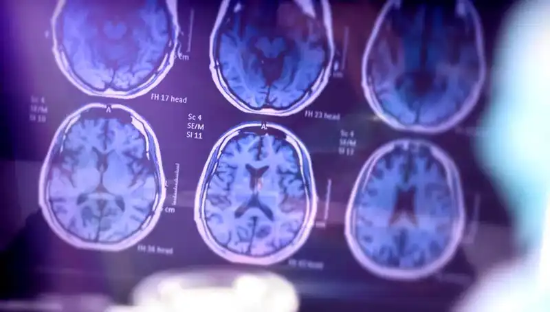 Alzheimer Önlenebilir mi? Çığır Açan Araştırma