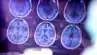 Alzheimer Önlenebilir mi? Çığır Açan Araştırma